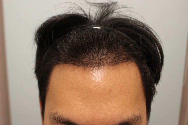수술후 13일 1.JPG