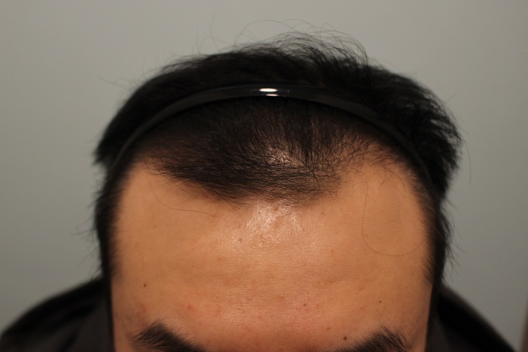 수술후 3개월 2.JPG