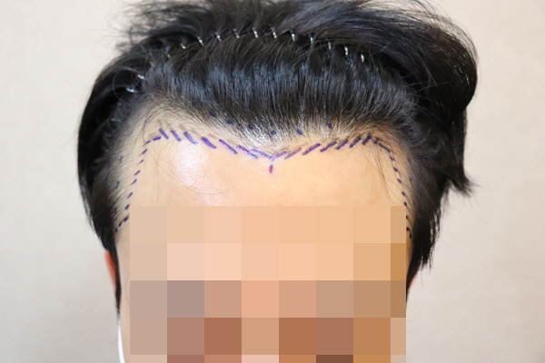 JP성형외과 2600모 모발이식 후기