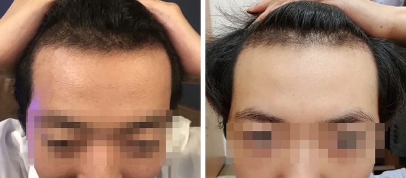 JP성형외과 비절개 슬릿 3500모 5주차 후기입니다.