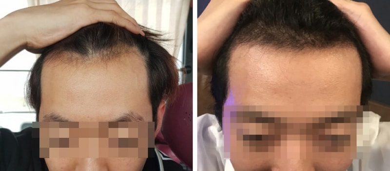 JP성형외과 비절개 슬릿 3500모 이식 3주차 두번째 후기