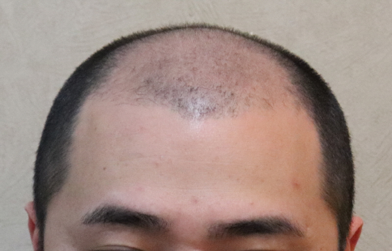 제이피 성형외과 정수리 6450모 6개월 후기입니다