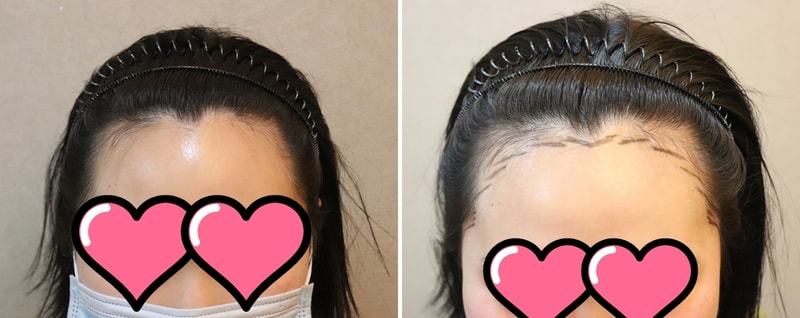 JP(제이피)성형외과 비절개 2700모 M자이마 얼마전에 수술 했어요~!!