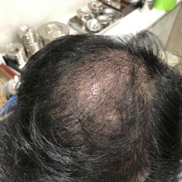 수술 1일차.jpg
