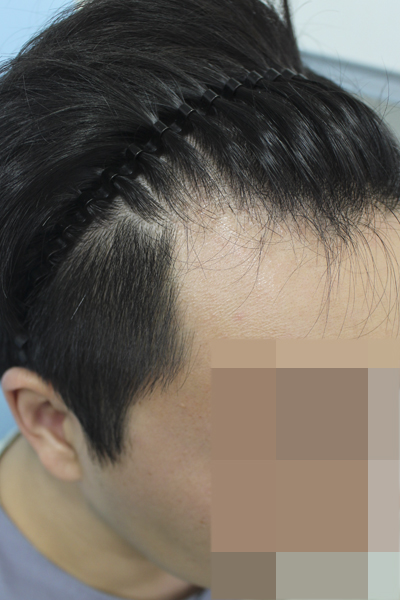 이식 받고 와서 후기 남깁니다 (절개 2800)