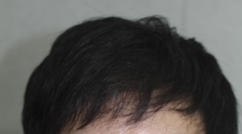 수술후6달경과 (2).png