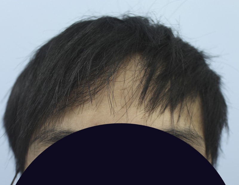 절개 3400모 이식해서 후기를 남겨봅니다