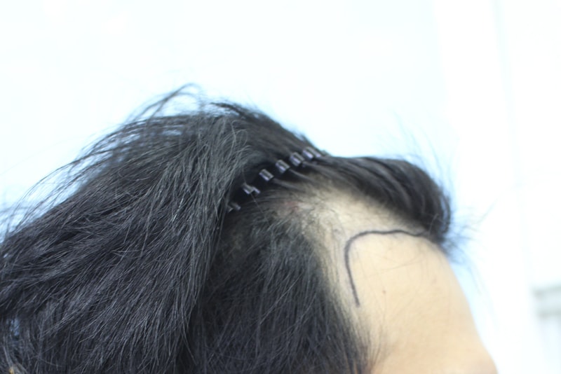 절개로 3800모 이식을 했는데 적당한가요?