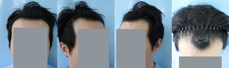 절개 3천모로 이식했는데 봐주세요!