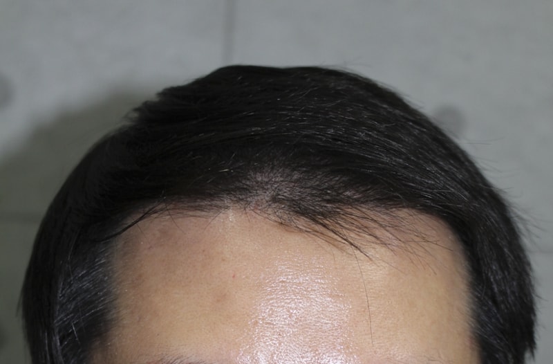 수술후4달 경과 1.png