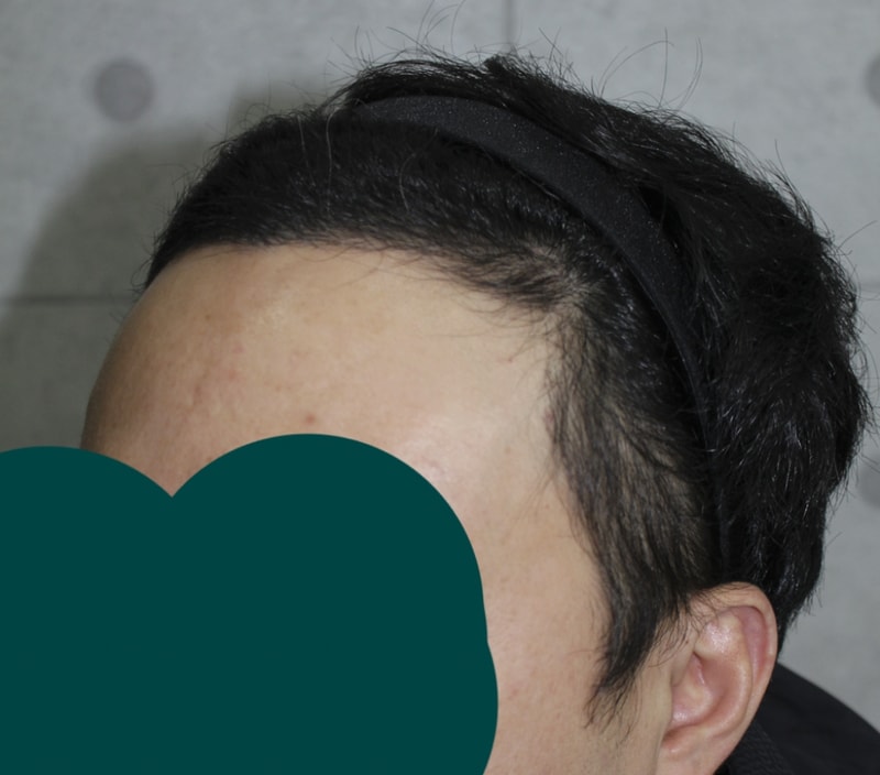 수술후5달경과 (4).png