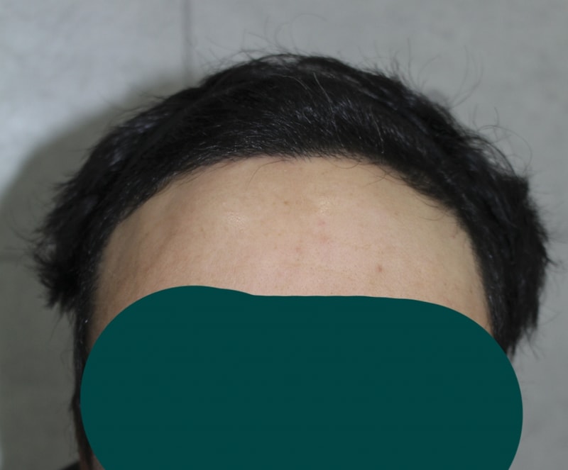 수술후5달경과 (2).png