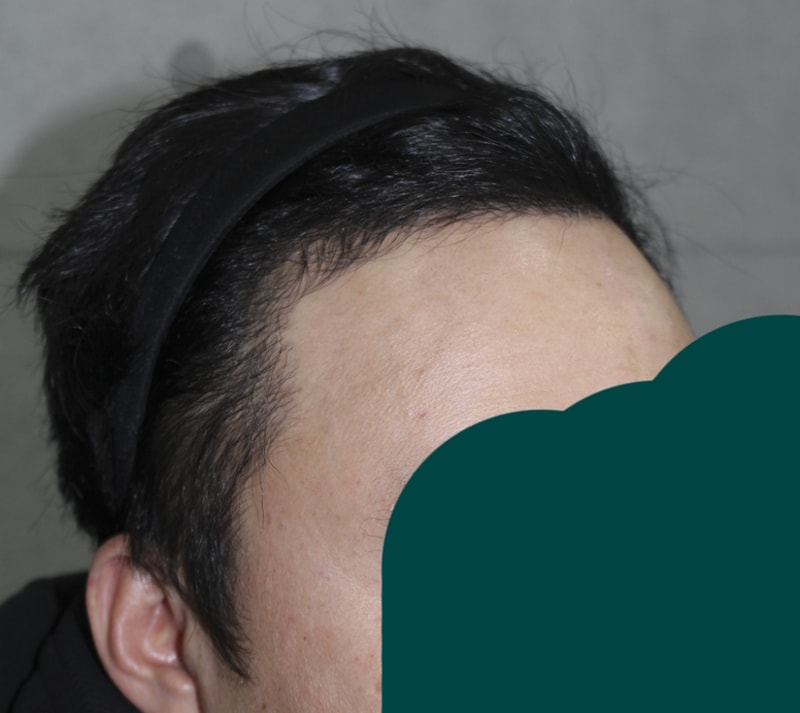 수술후5달경과 (3).png