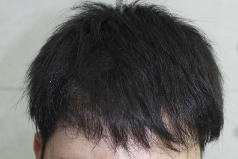 이식7개월 (5).png