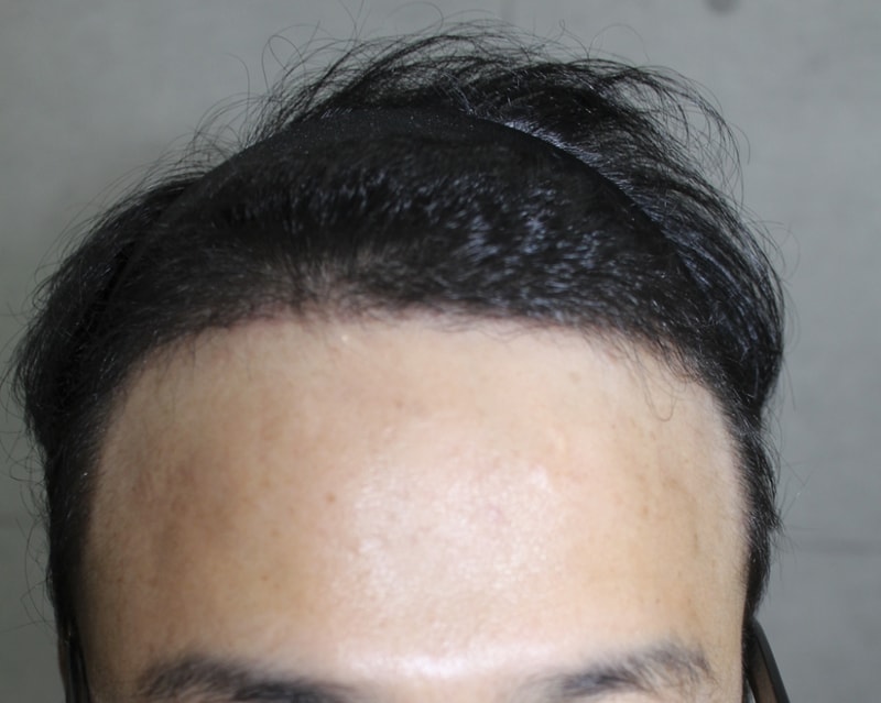 수술후4달경과 (1).png
