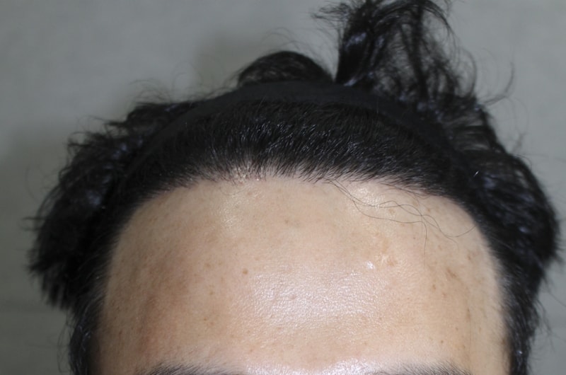 수술후9개월 (6).png
