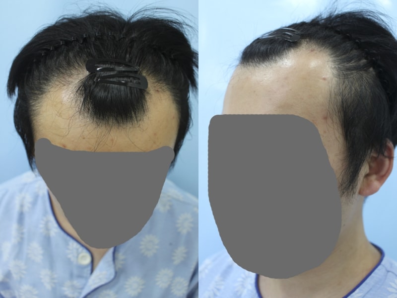 절개 3500모로 M자 이식 받았어요 :)