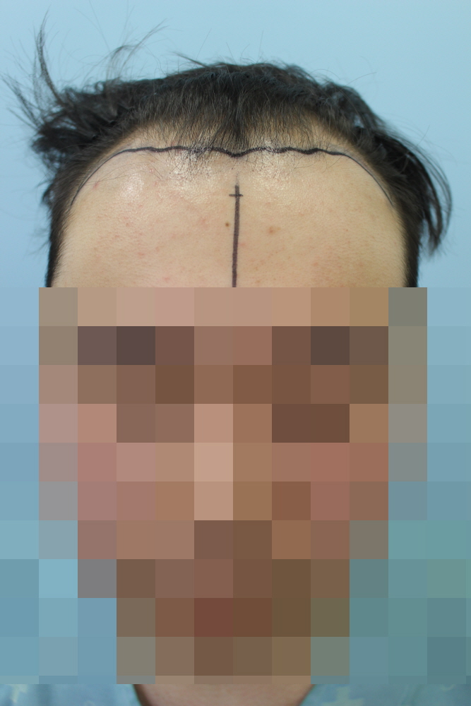 M자 이식을 했는데 봐주셨으면 해서요