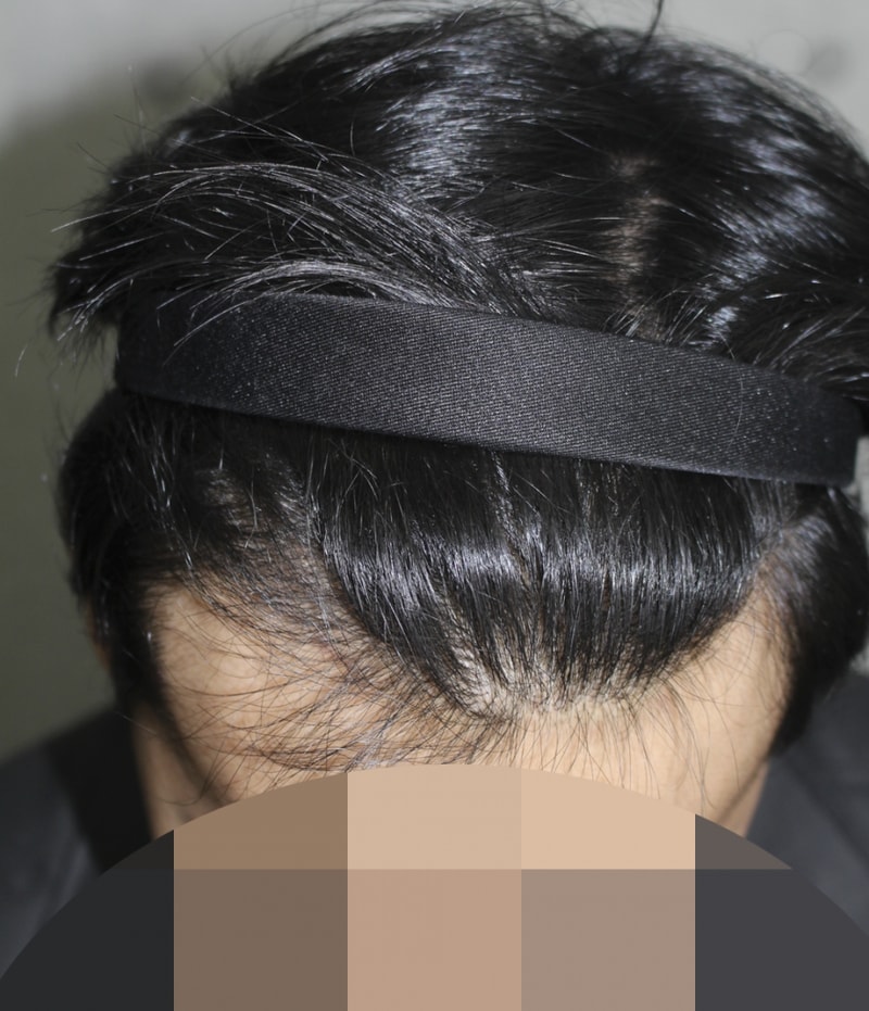 수술후7달째 (5).png
