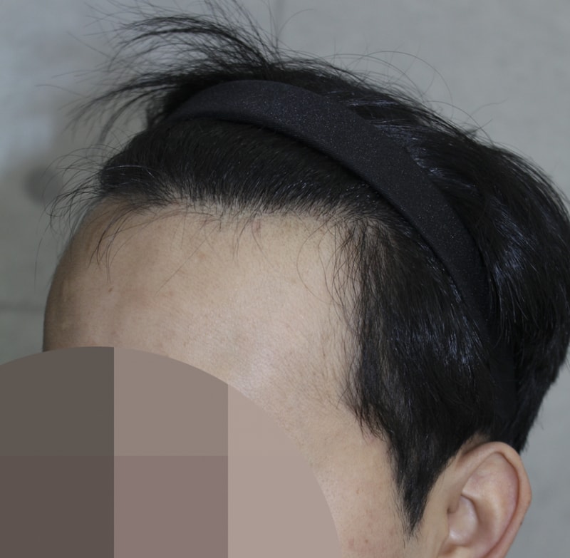 수술후7달째 (3).png