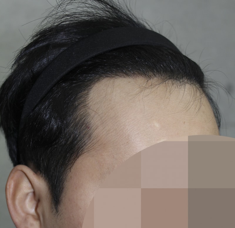 수술후7달째 (2).png