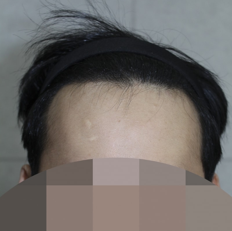 M자+옆선 절개 3000모 7개월 됐습니다