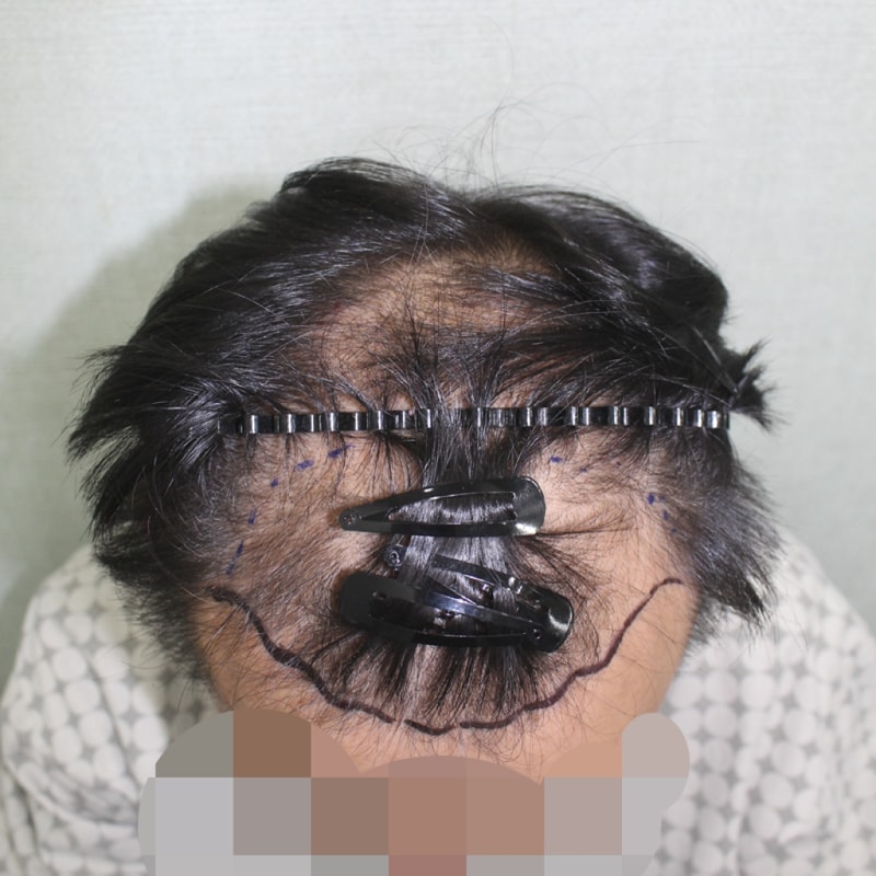 이 창석_20160808_모발_39709.png