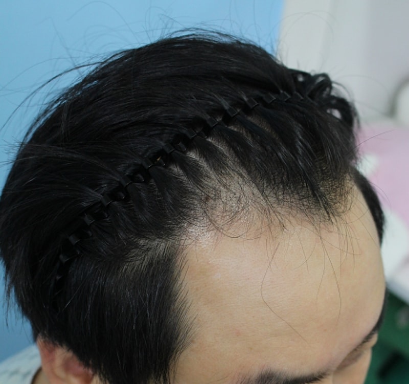 수술전 측면.PNG