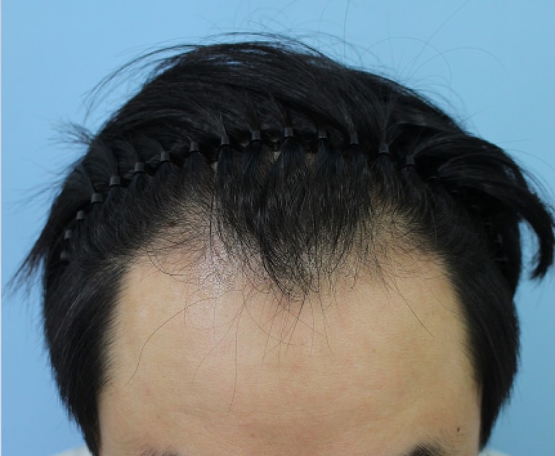 수술전 윗면.PNG