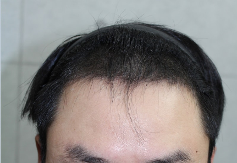 3개월 후 정면.PNG