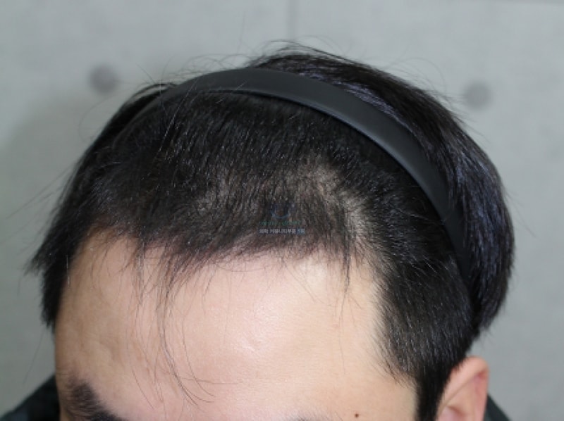 3개월 측면2.PNG