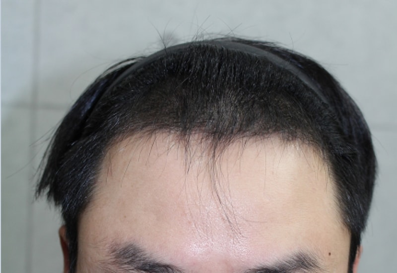 3개월 후 정면.PNG
