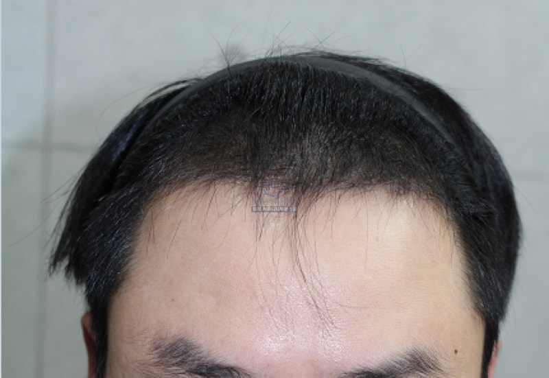 3개월 정면.PNG