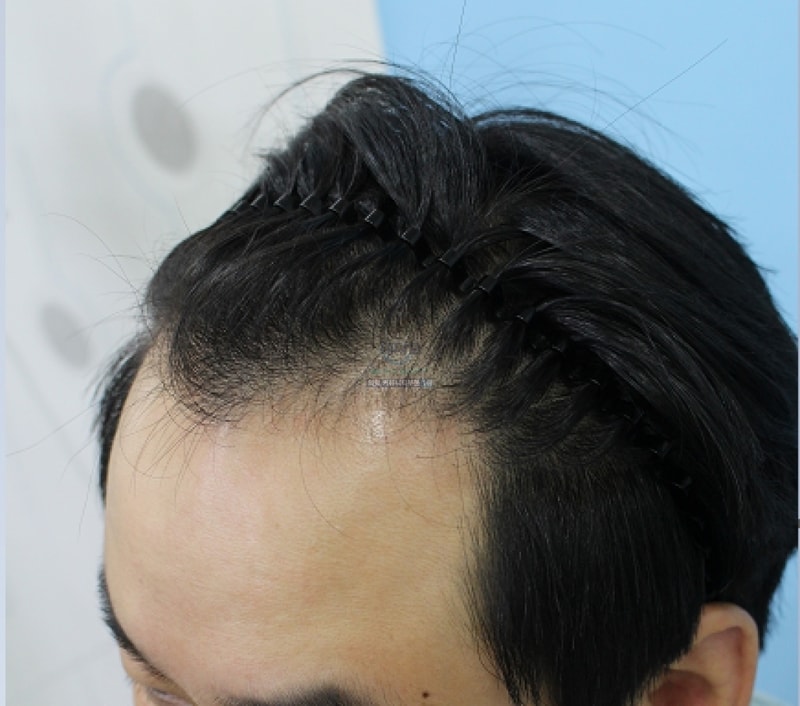 수술전 측면2.PNG