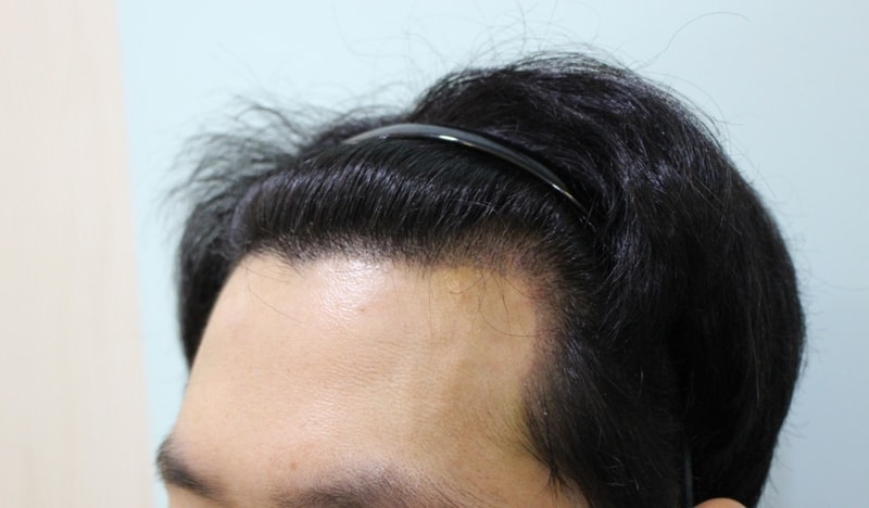이식 딱지제거 후.jpg