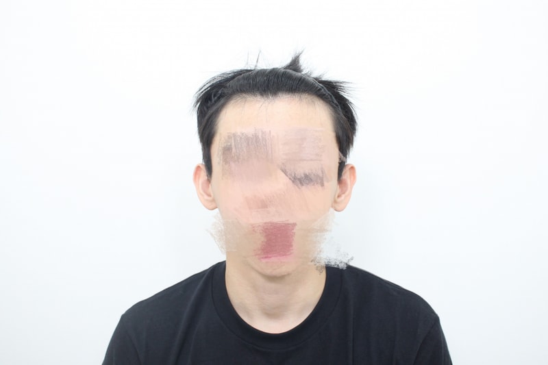 모프로의원 비절개 라인컷 3200모 6개월 경과 입니다