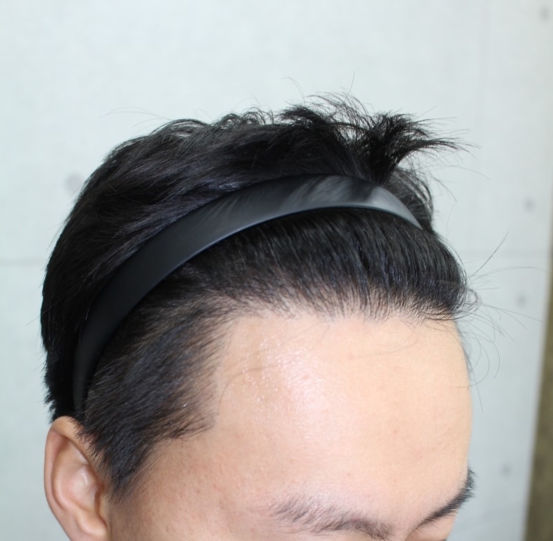 수술후 1년 측면2.jpg