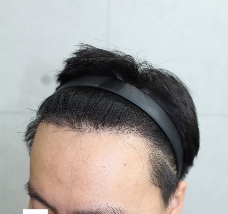 수술후 1년 측면1.jpg