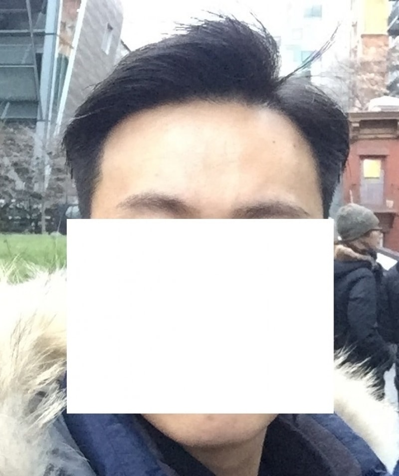 수술 후 11개월.jpg