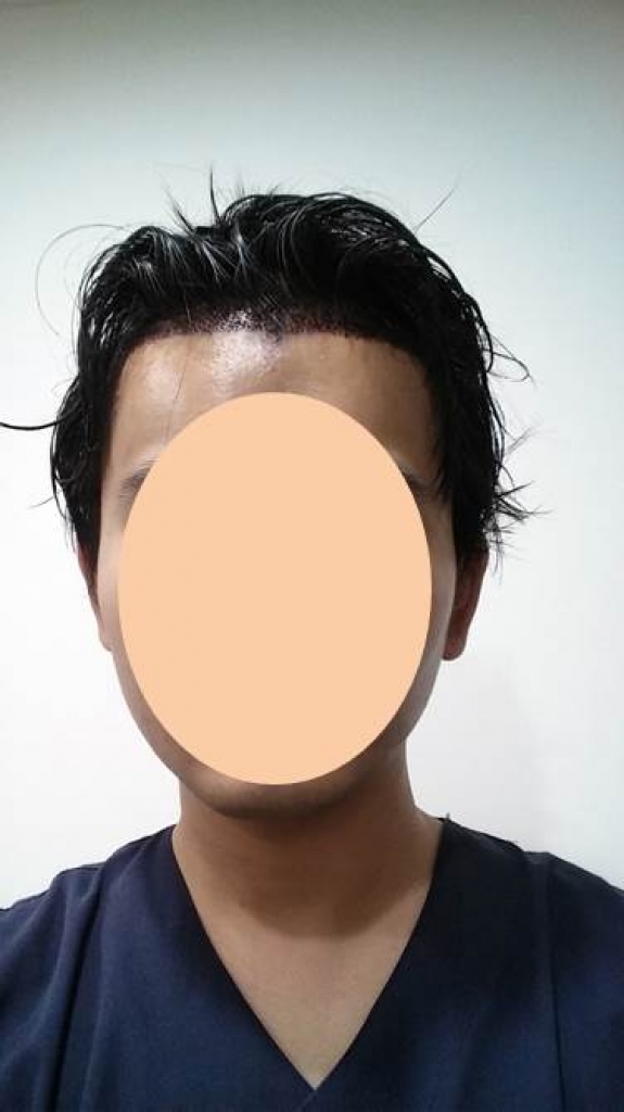 수술 하루 후 (정면).jpg
