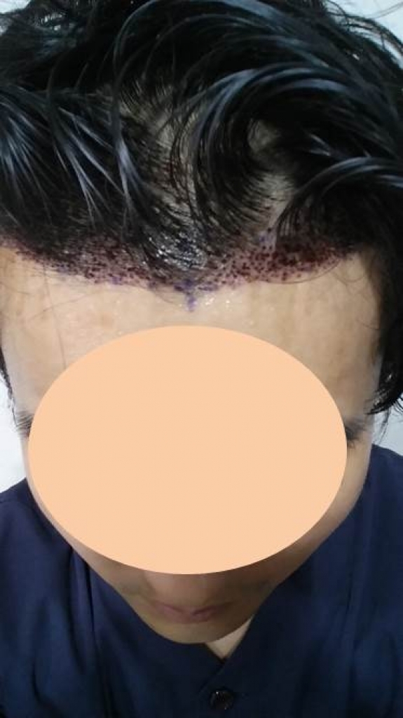 수술 하루 후 (위).jpg