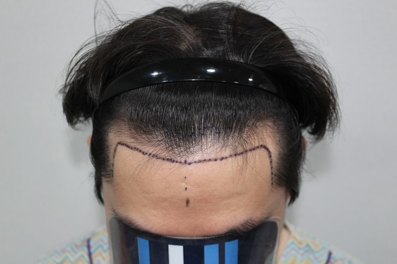 A review of the M.J. incision at Moderna hospital the day after the surgery