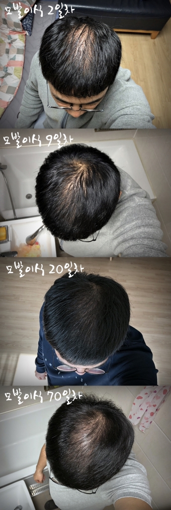 모발이식.jpg