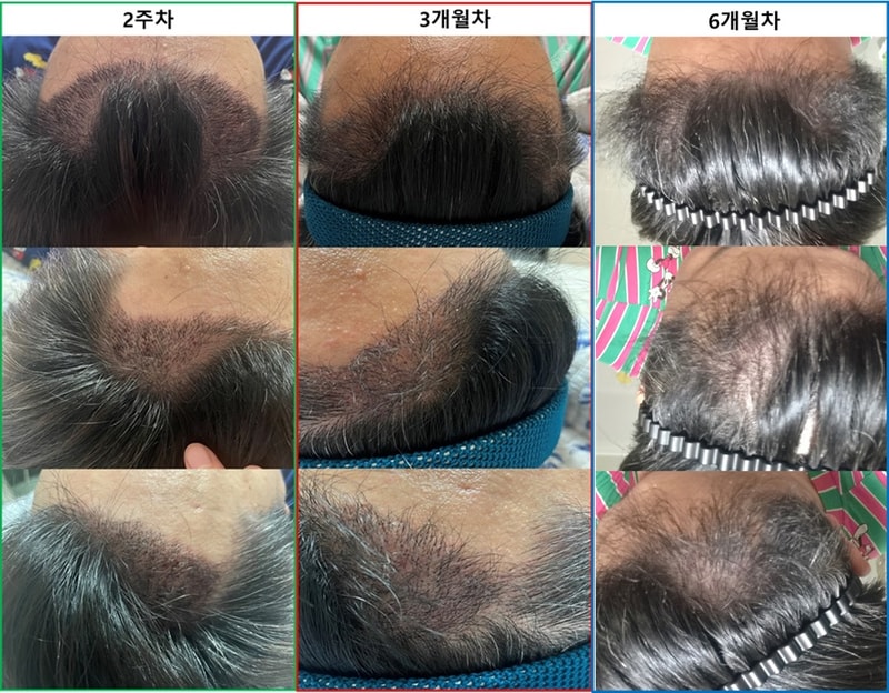 인천 마이모의원 비절개 1400모낭 6개월차 후기