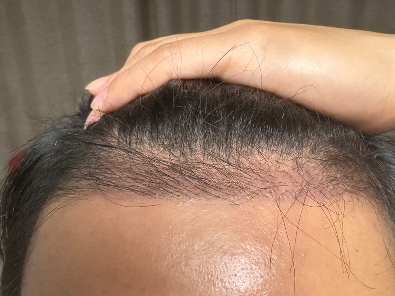 4,000-mo post-mortem incision in Umchan Clinic (3 months)