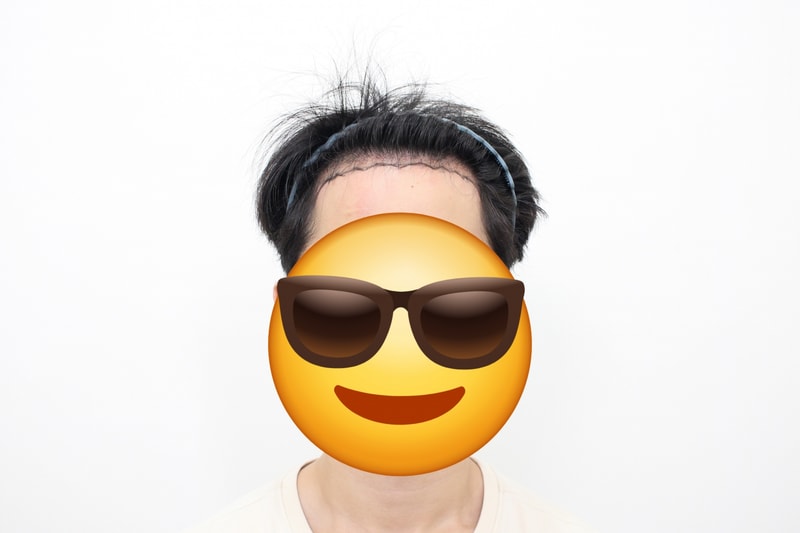 M자 모발 이식 3400모 7개월 경과