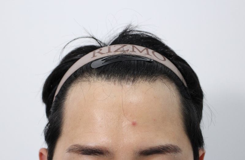 부산리즈모의원 8개월 후기