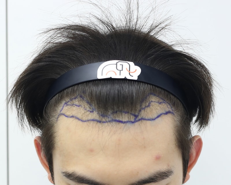 수술 전.jpg