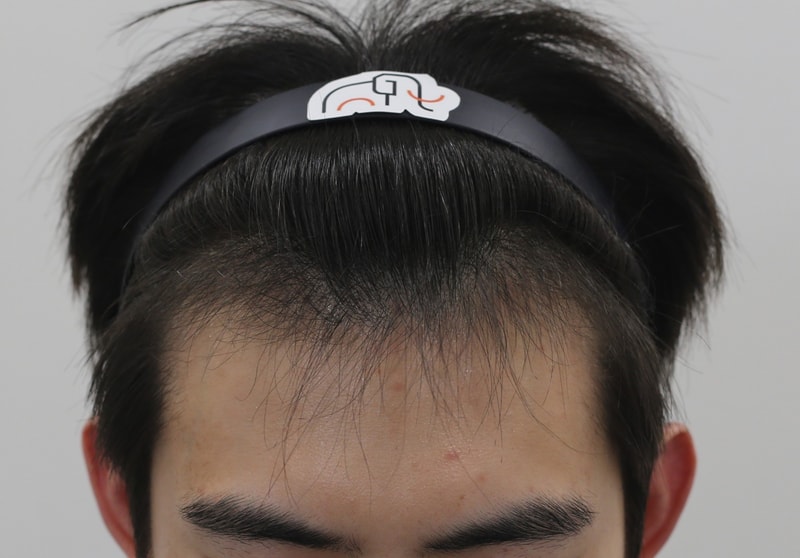 수술 4개월차.jpg
