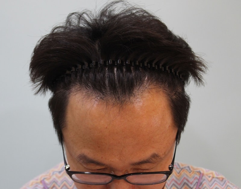 수술전.jpg